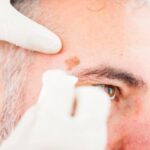What is Actinic keratosis? what are the causes and symptoms of it?
