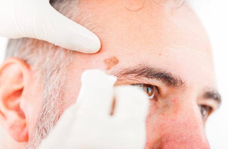 What is Actinic keratosis? what are the causes and symptoms of it?