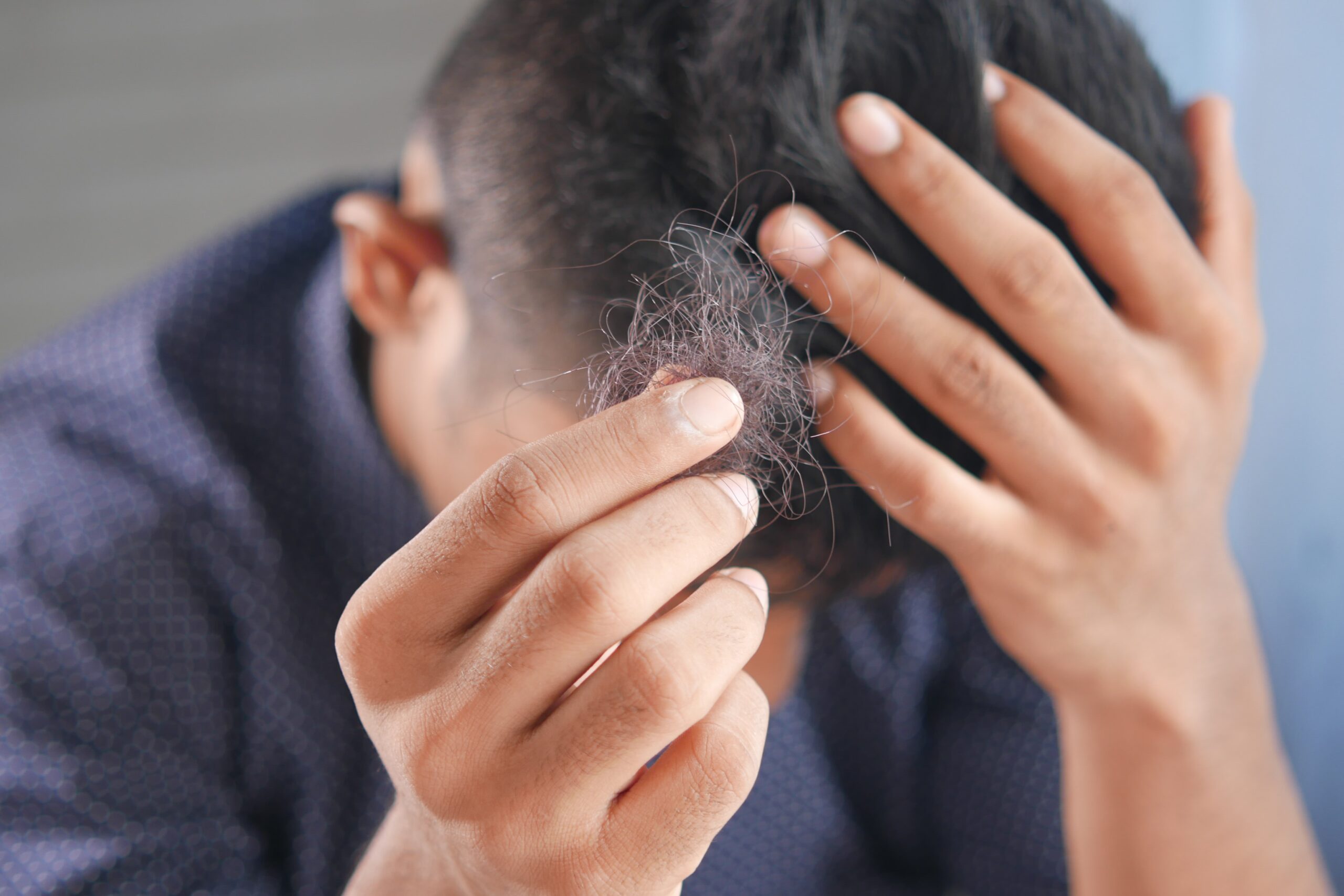 8 Tips For Finding The Best Hair Loss Solutions That Deliver Results