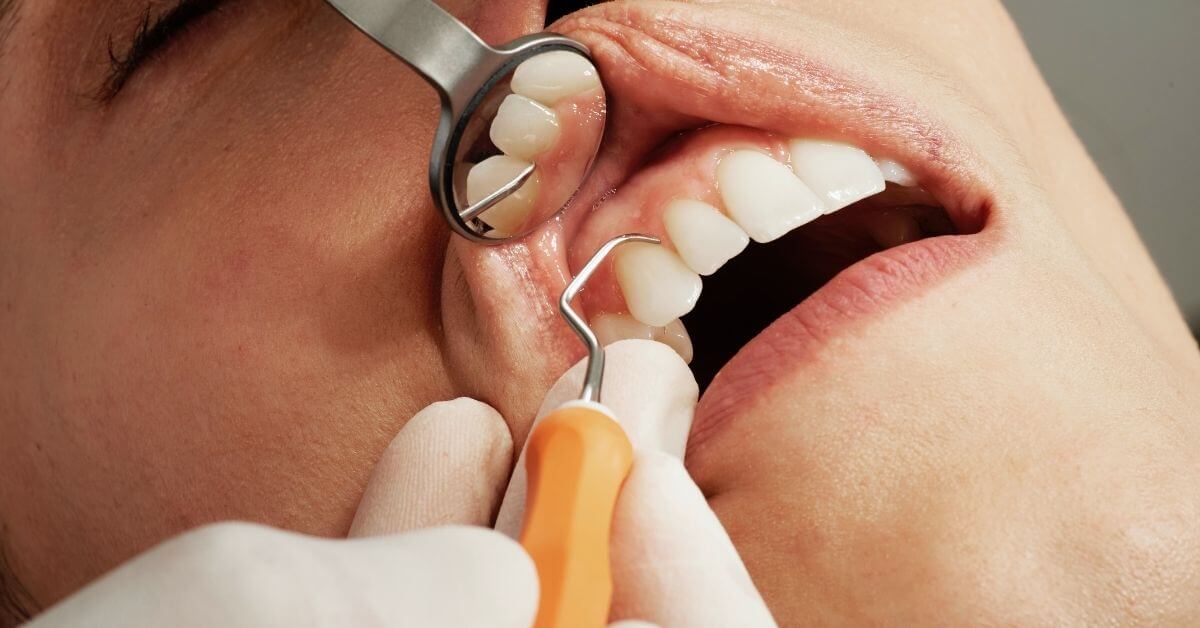 What are Routine Dental Procedures